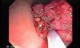 Tubulo - Villous Rectal Adenoma - Endoscopy (5 of 35)