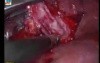 Hepatic Hydatid Cyst - Laparoscopic Total Pericystectomy