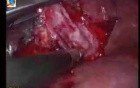 Hepatic Hydatid Cyst - Laparoscopic Total Pericystectomy