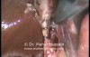 Transumbilical Cholecystomy - Laparoscopy