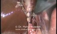 Transumbilical Cholecystomy - Laparoscopy