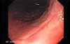 Chronic Gastritis (2 of 8)