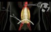 Surgical Repair Option for Aortic Aneurysm