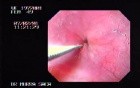 Esophageal Achalasia (5 of 7)