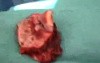 The Cervicofacial Advancement Flap