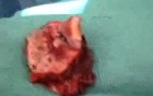 The Cervicofacial Advancement Flap