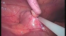 Appendicectomy - SILS 