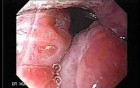 Enlarged Tonsils (2 of 2)