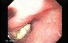 Esophageal Squamous Cell Carcinoma of the the Upper Third of the Esophagus that Invaded the Subglottis - Biopsies
