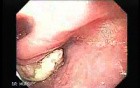 Esophageal Squamous Cell Carcinoma of the the Upper Third of the Esophagus that Invaded the Subglottis - Biopsies