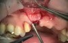Anterior 3.0/2 Piece Implant Bridge