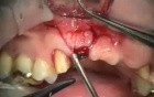 Anterior 3.0/2 Piece Implant Bridge