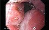 Enlarged tonsils - endoscopic view 2/2, chronic tonsilitis