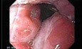 Enlarged tonsils - endoscopic view 2/2, chronic tonsilitis
