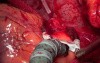 Full Arterial Off Pump Coronary Artery Bypass Grafting - 48 y.o. Male Patient