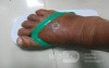 Diabetic Foot Ulcer - Edema - Non Medicated Shoes