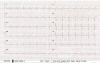 ECG - Brugada Syndrome