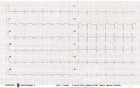 ECG - Brugada Syndrome