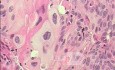 Perforation of a Esophageal Carcinoma after the procedure
 with hydrostatic balloon dilation (11 of 12)