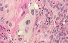 Perforation of a Esophageal Carcinoma after the procedure
 with hydrostatic balloon dilation (11 of 12)