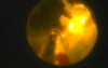 Greenlight HPS Prostatectomy
