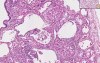 Sarcoidosis - Histopathology - Lung