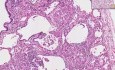 Sarcoidosis - Histopathology - Lung