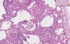 Sarcoidosis - Histopathology - Lung