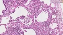 Sarcoidosis - Histopathology - Lung