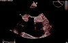 Lipomatous Hypertrophy of the Atrial Septum (LHAS) - Video nr 1
