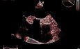 Lipomatous Hypertrophy of the Atrial Septum (LHAS) - Video nr 1