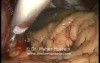 Redo Nissen Fundoplication - Laparoscopy