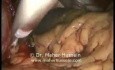 Redo Nissen Fundoplication - Laparoscopy
