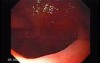 Colonic Interposition for Esophageal Substitution (5 of 11)