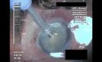 Cataract Surgery I - 1