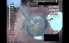 Cataract Surgery I - 1