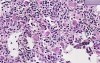 Gaucher disease - Histopathology of spleen 