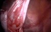 Laparoscopic Cystectomy 