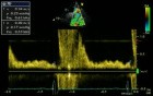 Reverse Diastolic Flow - Descending Aorta