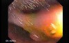 Colonoscopic Polypectomy (3 of 29)