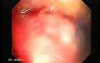 Familial Adenomatous Polyposis (26 of 36)