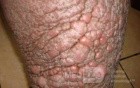 Elephantiasis nostras verrucosa on the legs with morbid
 obesity (2 of 5)