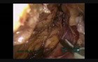 Resection Of Hepatic Flexure Carcinoma - Laparoscopic Extended Right Hemicolectomy