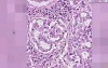 Adenocarcinoma - Histopathology - Lung
