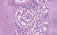 Adenocarcinoma - Histopathology - Lung