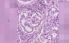 Adenocarcinoma - Histopathology - Lung