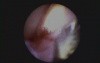 An Antibiotic Treatment For Periodontal Disease - Arestin