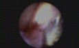 An Antibiotic Treatment For Periodontal Disease - Arestin