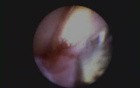 An Antibiotic Treatment For Periodontal Disease - Arestin