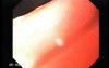 Squamous cell carcinoma of the larynx (4 of 4)